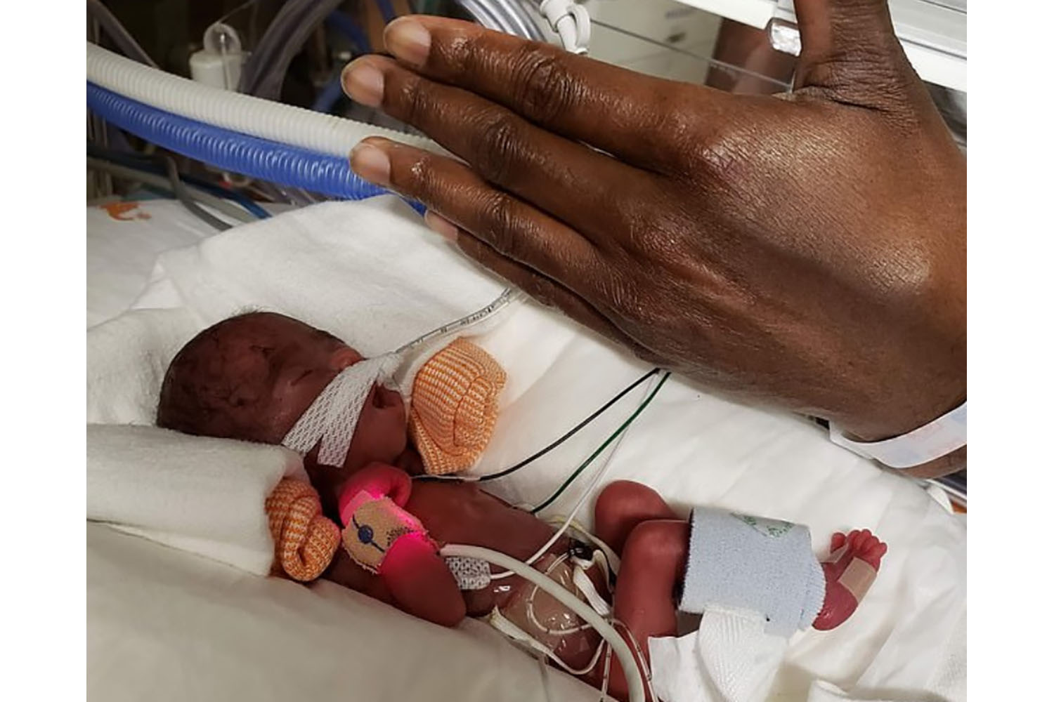 DISRN Baby born 16 weeks premature goes home healthy